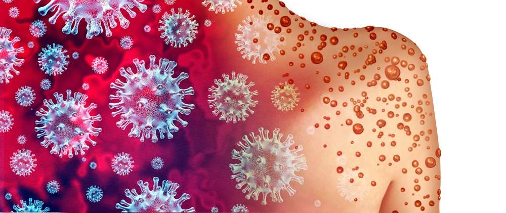 Illustration of the monkeypox virus in foreground blending into a human back with rashy lesions on it.